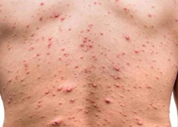 Itapetininga tem dois casos confirmados da nova varíola