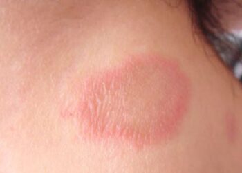 A hanseníase é uma doença crônica, causada pela bactéria Mycobacterium leprae, que pode afetar qualquer pessoa. (Divulgação/Prefeitura de Itapetininga)