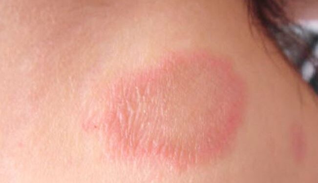 A hanseníase é uma doença crônica, causada pela bactéria Mycobacterium leprae, que pode afetar qualquer pessoa. (Divulgação/Prefeitura de Itapetininga)