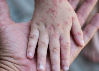 Causada por um vírus, ela provoca pequenas bolhas pelo corpo e é mais frequente em crianças, principalmente as menores de 5 anos. (Agência Brasil)