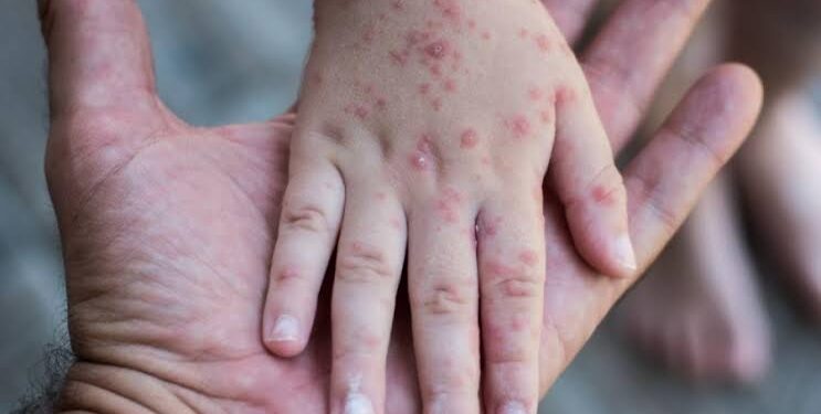 Causada por um vírus, ela provoca pequenas bolhas pelo corpo e é mais frequente em crianças, principalmente as menores de 5 anos. (Agência Brasil)