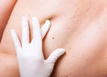 O câncer de pele é o tipo de tumor maligno mais frequente no Brasil e, de acordo com o Ministério da Saúde, corresponde a cerca de 30% de todos os cânceres no país. Conteúdo copiado de https://viverbem.unimedbh.com.br/prevencao-e-controle/cancer-de-pele. (Divulgação)