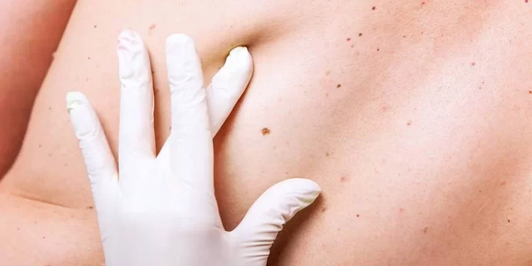 O câncer de pele é o tipo de tumor maligno mais frequente no Brasil e, de acordo com o Ministério da Saúde, corresponde a cerca de 30% de todos os cânceres no país. Conteúdo copiado de https://viverbem.unimedbh.com.br/prevencao-e-controle/cancer-de-pele. (Divulgação)